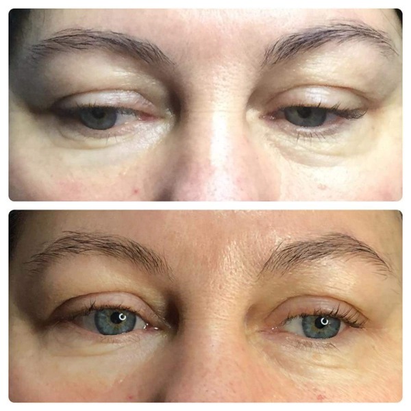 Eye bags reduction