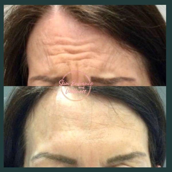 Forehead line reduction