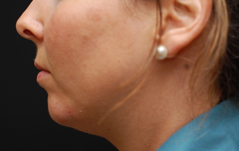 After chin augmentation 
