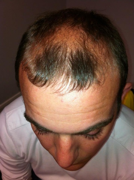 Hair Loss - Drugs (Minoxidil, Propecia) to Treat Baldness & Alopecia