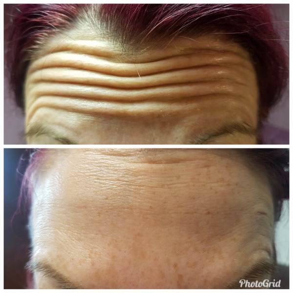Anti-wrinkle forehead treatment Photo