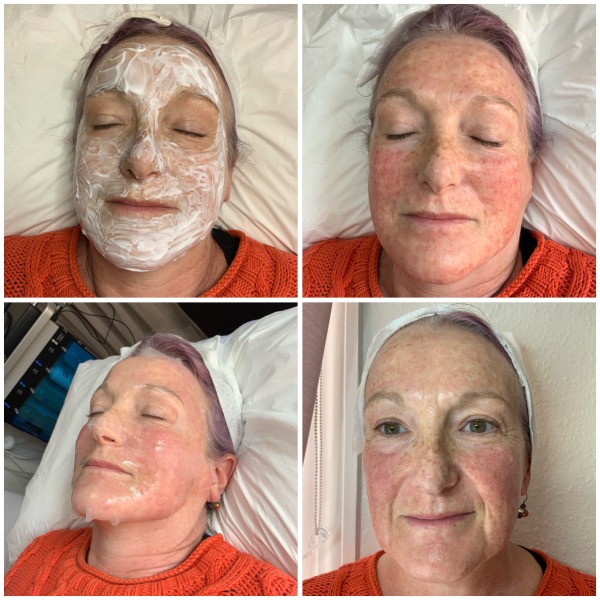 Before, during and after Medical needling treatment Photo