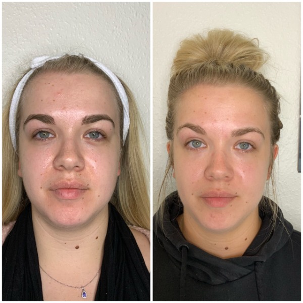 Before and after 3 HydraFacials