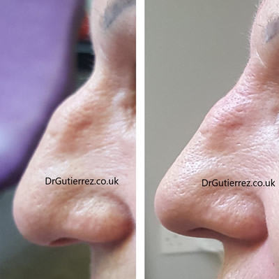 Nose filler by Dr Ricardo