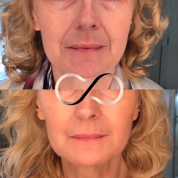 Mid-Facial volume restoration with medical grade skincare.