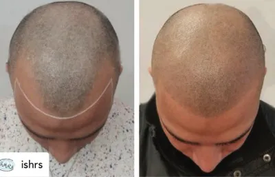 before and after hair loss treatment