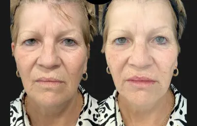 Before and After Skin Rejuvenation Treatment front view