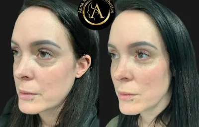 Before and After Skin Rejuvenation Treatment