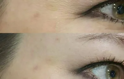 Before and after skin rejuvenation treatment