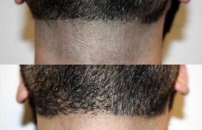 Laser hair removal before and after