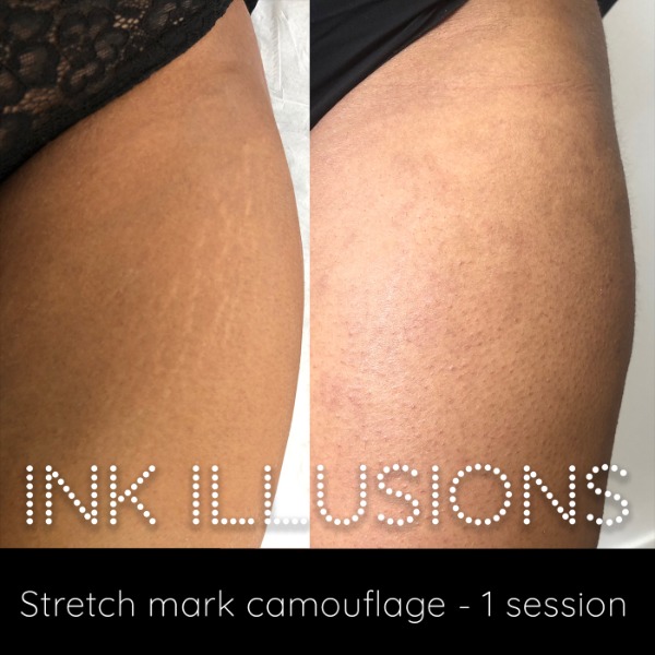 Stretch mark tattoo camouflage