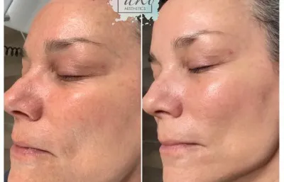 Skin rejuvenation before and after