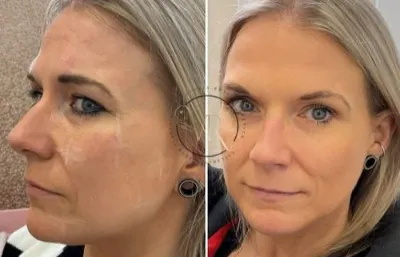before and after a rejuvenation treatment