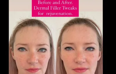 Before and after Dermal filler treatment