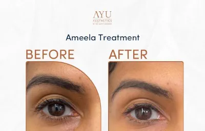 before and after eye treatment at AYU Aesthetics