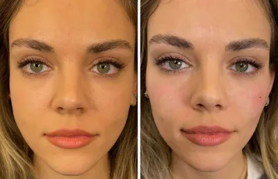 Before and after full facial contouring treatment