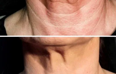 Before and after neck rejuvenation treatment