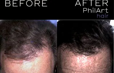 Before and after hair rejuvenation treatment