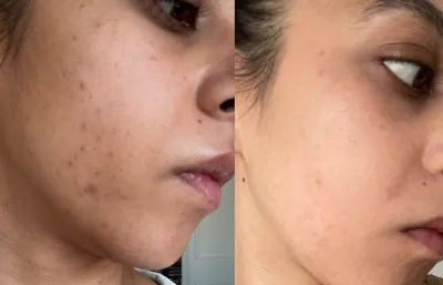 Before and after acne and pigmentation treatment Photo