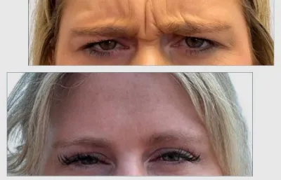 Before and after Frown line treatment Photo