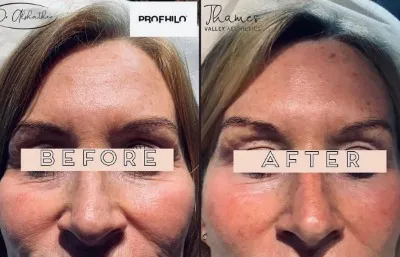 Before and after Profhilo treatment Photo