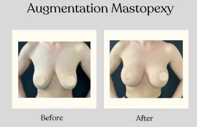 Before and after augmentation mastopexy treatment Photo