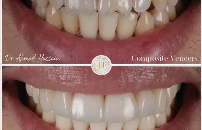 Before and after composite vaneer treatment