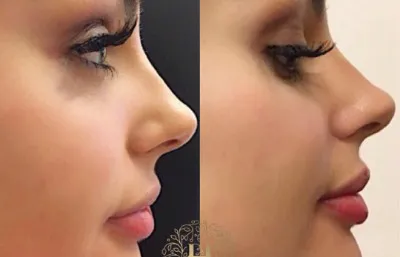 Before and after skin rejuvenation treatment Photo