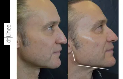 Before and after male facial augmentation treatment Photo
