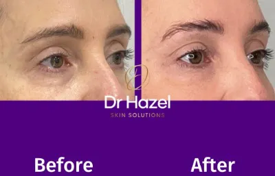 Tear trough filler treatment Photo