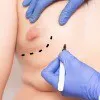 Gynaecomastia ( Man Boobs or Moobs ) Thumbnail