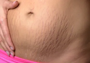 Stretch Marks ( Striae ) clinics