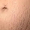 Stretch Marks ( Striae ) Thumbnail