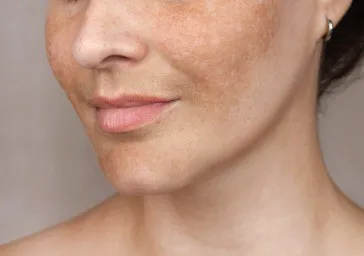 Pigmentation ( Age Spots, Brown Spots ) clinics