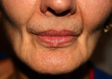Sunken Cheeks clinics