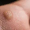 Moles, Warts, Skin Tags and Benign Growths Thumbnail