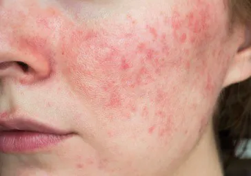 Rosacea clinics