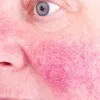Rosacea Thumbnail