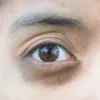 Eyes - Tear Trough ( Dark Circles ) Thumbnail