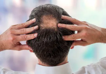 Hair Loss ( Male Pattern Baldness, Alopecia ) clinics