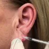 Ear Lobe Rejuvenation Thumbnail