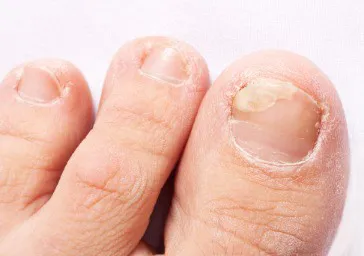 Fungal Nail Infection ( Onychomycosis ) clinics