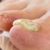 Fungal Nail Infection ( Onychomycosis ) Thumbnail