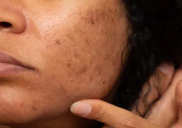 Melasma (Chloasma) clinics