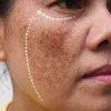 Melasma (Chloasma) Thumbnail