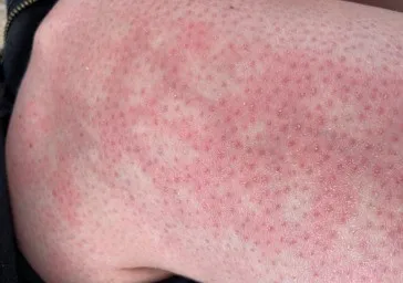 Toasted Skin Syndrome