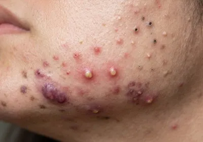 Acne Develops in the Skin Image
