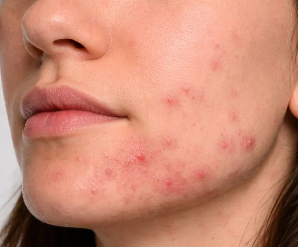 Acne focus on jawline and chin