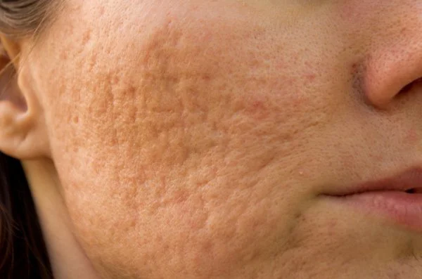 Acne scarring