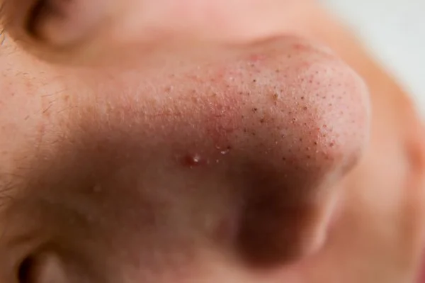Blackheads